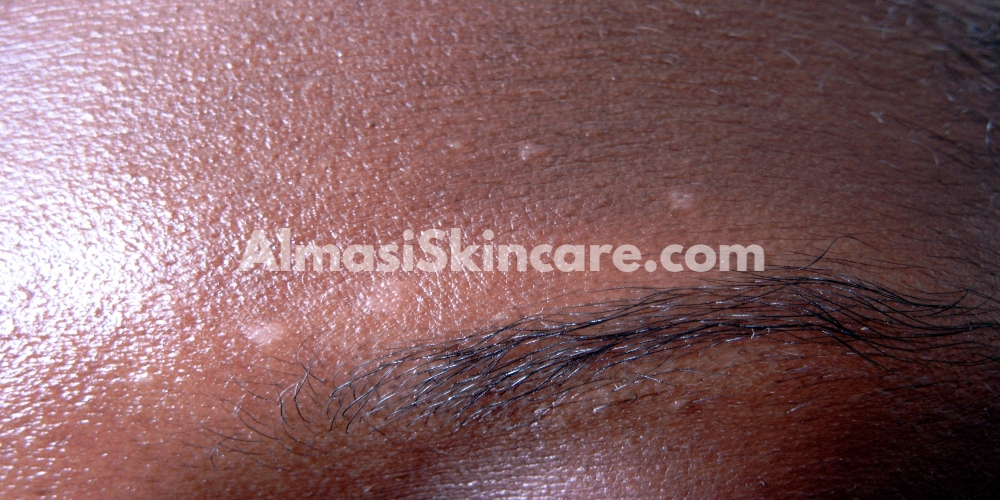 Pictures of Skin Diseases in Kenya - Almasi Skincare