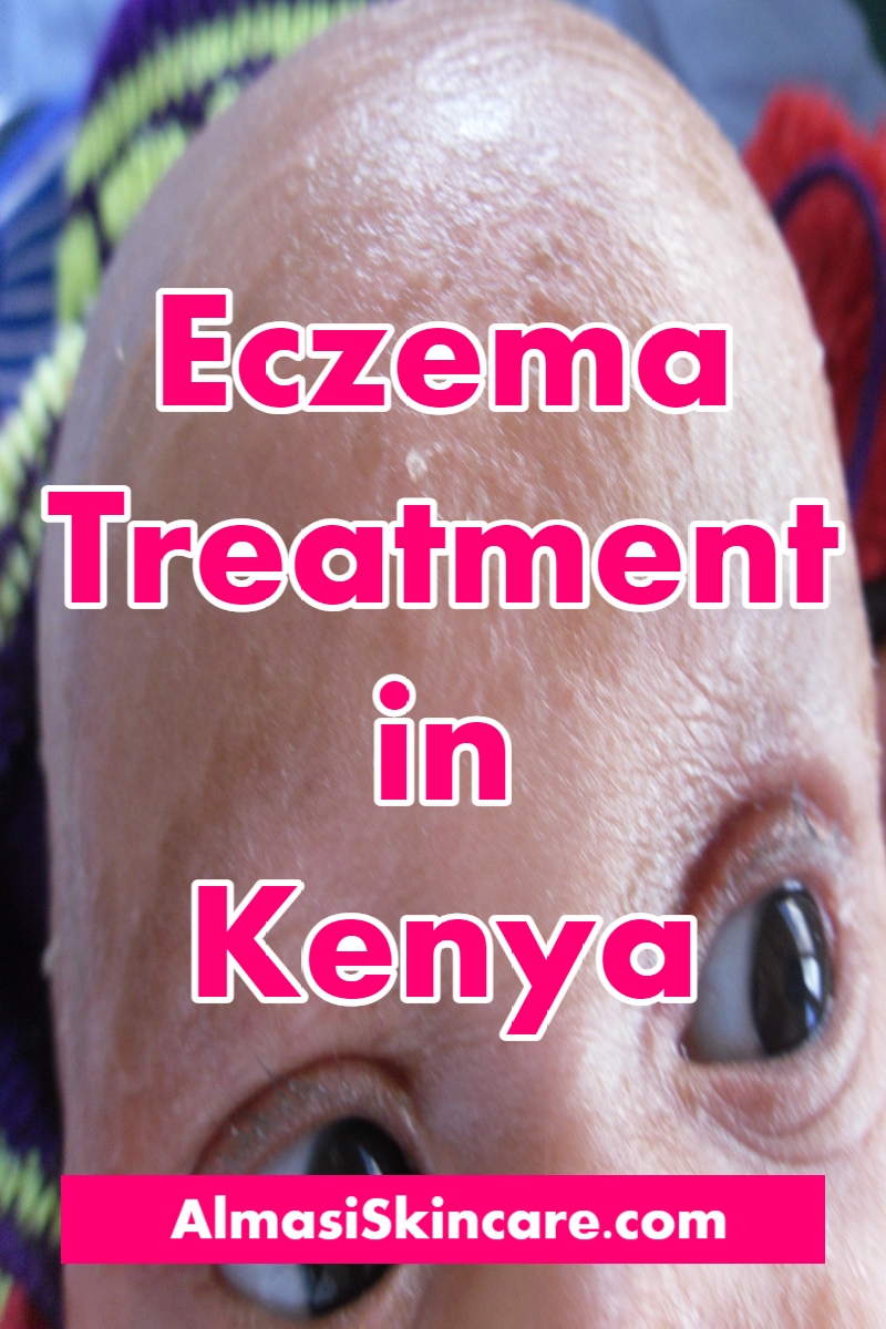 Eczema Treatment In Nairobi Kenya - Almasi Skincare